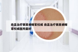 南昌治疗银屑病哪家权威 南昌治疗银屑病哪家权威医院最好