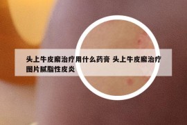 头上牛皮廨治疗用什么药膏 头上牛皮廨治疗图片腻脂性皮炎