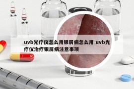 uvb光疗仪怎么用银屑病怎么用 uvb光疗仪治疗银屑病注意事项