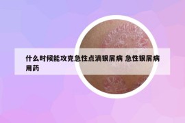 什么时候能攻克急性点滴银屑病 急性银屑病用药