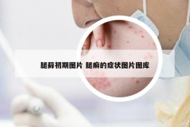 腿藓初期图片 腿癣的症状图片图库