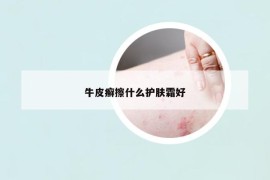 牛皮癣擦什么护肤霜好