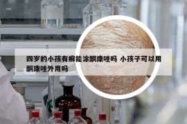 四岁的小孩有癣能涂酮康唑吗 小孩子可以用酮康唑外用吗