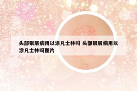 头部银屑病用以涂凡士林吗 头部银屑病用以涂凡士林吗图片