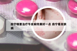 南宁哪里治疗牛皮癣效果好一点 南宁看皮肤病