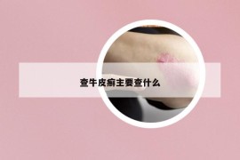 查牛皮癣主要查什么