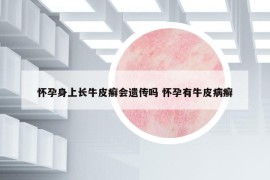 怀孕身上长牛皮癣会遗传吗 怀孕有牛皮病癣