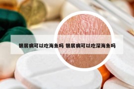 银屑病可以吃海鱼吗 银屑病可以吃深海鱼吗