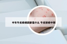 中年牛皮癣病因都是什么 牛皮肤癣中期