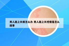 男人腿上长癣怎么办 男人腿上长疙瘩是怎么回事