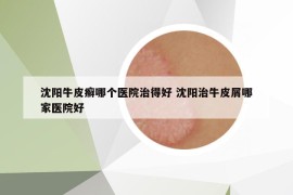 沈阳牛皮癣哪个医院治得好 沈阳治牛皮屑哪家医院好