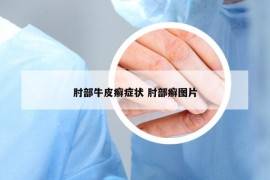 肘部牛皮癣症状 肘部癣图片