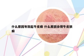 什么原因导致起牛皮癣 什么原因会得牛皮肤癣