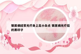 银屑病经常光疗身上出小白点 银屑病光疗后的黑印子