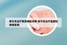 萌尔夫治疗银屑病起效期 萌尔夫治疗面部轻微银屑病