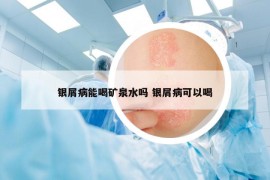 银屑病能喝矿泉水吗 银屑病可以喝