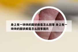 身上有一块块的圈状癣是怎么回事 身上有一块块的圈状癣是怎么回事图片