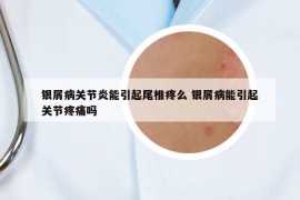 银屑病关节炎能引起尾椎疼么 银屑病能引起关节疼痛吗