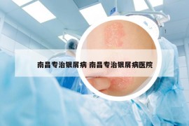 南昌专治银屑病 南昌专治银屑病医院