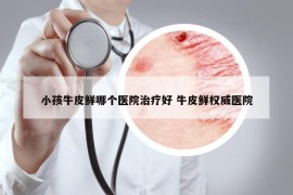 小孩牛皮鲜哪个医院治疗好 牛皮鲜权威医院