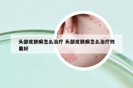 头部皮肤癣怎么治疗 头部皮肤癣怎么治疗效果好