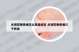 点滴型银屑病怎么算是痊愈 点滴型银屑病三个阶段