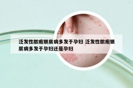 泛发性脓疱银屑病多发于孕妇 泛发性脓疱银屑病多发于孕妇还是孕妇