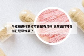 牛皮癣进行期打可善挺有用吗 银屑病打可善挺已经没效果了