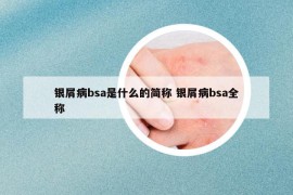 银屑病bsa是什么的简称 银屑病bsa全称