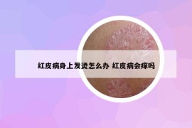 红皮病身上发烫怎么办 红皮病会痒吗