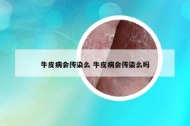 牛皮病会传染么 牛皮病会传染么吗