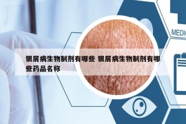 银屑病生物制剂有哪些 银屑病生物制剂有哪些药品名称