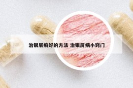 治银屑癣好的方法 治银屑病小窍门