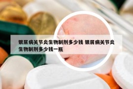 银屑病关节炎生物制剂多少钱 银屑病关节炎生物制剂多少钱一瓶