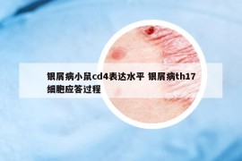 银屑病小鼠cd4表达水平 银屑病th17细胞应答过程