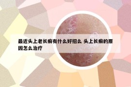 最近头上老长癣有什么好招么 头上长癣的原因怎么治疗