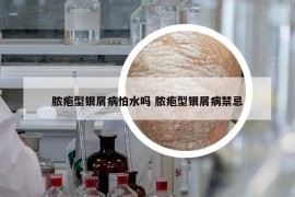 脓疱型银屑病怕水吗 脓疱型银屑病禁忌