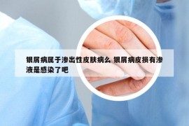 银屑病属于渗出性皮肤病么 银屑病皮损有渗液是感染了吧