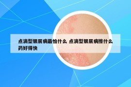 点滴型银屑病最怕什么 点滴型银屑病擦什么药好得快