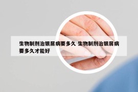 生物制剂治银屑病要多久 生物制剂治银屑病要多久才能好