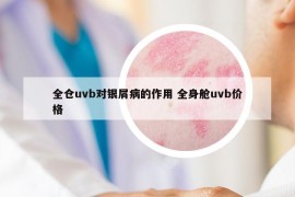 全仓uvb对银屑病的作用 全身舱uvb价格