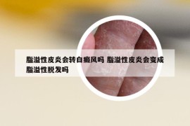 脂溢性皮炎会转白癜风吗 脂溢性皮炎会变成脂溢性脱发吗