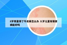 8岁男童得了牛皮癣怎么办 八岁儿童有银屑病能好吗