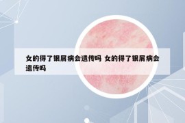 女的得了银屑病会遗传吗 女的得了银屑病会遗传吗