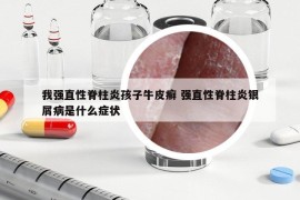 我强直性脊柱炎孩子牛皮癣 强直性脊柱炎银屑病是什么症状