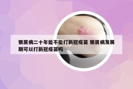 银屑病二十年能不能打新冠疫苗 银屑病发展期可以打新冠疫苗吗