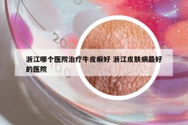 浙江哪个医院治疗牛皮癣好 浙江皮肤病最好的医院