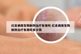 红皮病用生物制剂治疗有用吗 红皮病用生物制剂治疗有用吗多少钱