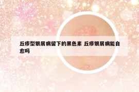 丘疹型银屑病留下的黑色素 丘疹银屑病能自愈吗