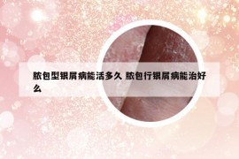 脓包型银屑病能活多久 脓包行银屑病能治好么